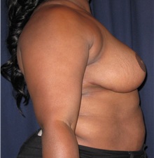 Breast Reduction After Photo by Gary Culbertson, MD, FACS; Sumter, SC - Case 33460
