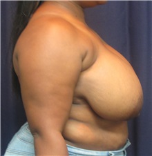 Breast Reduction Before Photo by Gary Culbertson, MD, FACS; Sumter, SC - Case 33460