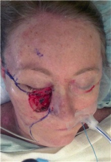 Head and Neck Skin Cancer Reconstruction Before Photo by Gary Culbertson, MD, FACS; Sumter, SC - Case 33462