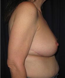Breast Reduction After Photo by Gary Culbertson, MD, FACS; Sumter, SC - Case 33463