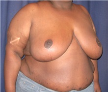 Breast Reduction After Photo by Gary Culbertson, MD, FACS; Sumter, SC - Case 33465