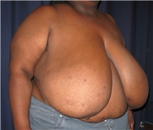 Breast Reduction Before Photo by Gary Culbertson, MD, FACS; Sumter, SC - Case 33465