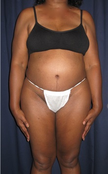 Tummy Tuck After Photo by Gary Culbertson, MD, FACS; Sumter, SC - Case 33466