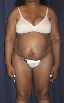 Tummy Tuck Before Photo by Gary Culbertson, MD, FACS; Sumter, SC - Case 33466
