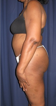 Tummy Tuck After Photo by Gary Culbertson, MD, FACS; Sumter, SC - Case 33466