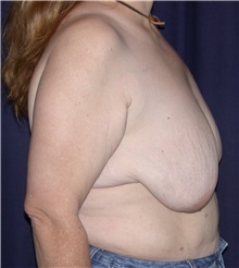 Breast Lift Before Photo by Gary Culbertson, MD, FACS; Sumter, SC - Case 33467