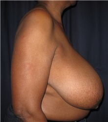 Breast Reduction Before Photo by Gary Culbertson, MD, FACS; Sumter, SC - Case 33469