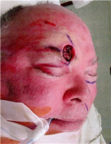 Head and Neck Skin Cancer Reconstruction Before Photo by Gary Culbertson, MD, FACS; Sumter, SC - Case 33470