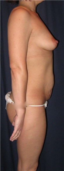 Tummy Tuck Before Photo by Gary Culbertson, MD, FACS; Sumter, SC - Case 33471