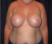 Breast Lift After Photo by Gary Culbertson, MD, FACS; Sumter, SC - Case 33472