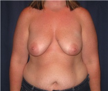 Breast Lift Before Photo by Gary Culbertson, MD, FACS; Sumter, SC - Case 33472