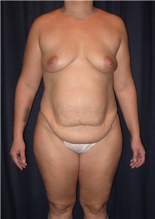 Tummy Tuck Before Photo by Gary Culbertson, MD, FACS; Sumter, SC - Case 33473
