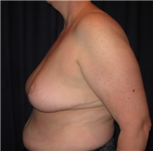 Breast Reduction After Photo by Gary Culbertson, MD, FACS; Sumter, SC - Case 33474