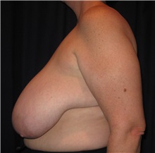 Breast Reduction Before Photo by Gary Culbertson, MD, FACS; Sumter, SC - Case 33474