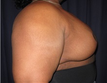 Breast Reduction After Photo by Gary Culbertson, MD, FACS; Sumter, SC - Case 33476