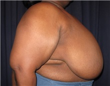 Breast Reduction Before Photo by Gary Culbertson, MD, FACS; Sumter, SC - Case 33476