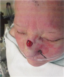 Head and Neck Skin Cancer Reconstruction Before Photo by Gary Culbertson, MD, FACS; Sumter, SC - Case 33477