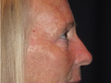 Eyelid Surgery After Photo by Gary Culbertson, MD, FACS; Sumter, SC - Case 33478