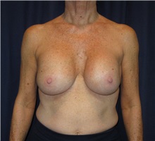 Breast Implant Removal Before Photo by Gary Culbertson, MD, FACS; Sumter, SC - Case 33479