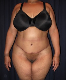 Tummy Tuck After Photo by Gary Culbertson, MD, FACS; Sumter, SC - Case 33480
