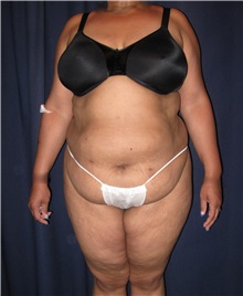 Tummy Tuck Before Photo by Gary Culbertson, MD, FACS; Sumter, SC - Case 33480