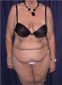 Tummy Tuck Before Photo by Gary Culbertson, MD, FACS; Sumter, SC - Case 33622