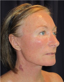 Facelift After Photo by Gary Culbertson, MD, FACS; Sumter, SC - Case 37761