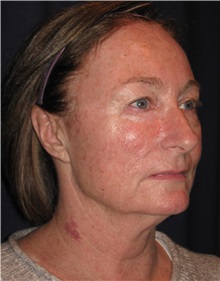 Facelift Before Photo by Gary Culbertson, MD, FACS; Sumter, SC - Case 37761