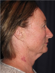 Facelift Before Photo by Gary Culbertson, MD, FACS; Sumter, SC - Case 37761