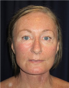 Facelift After Photo by Gary Culbertson, MD, FACS; Sumter, SC - Case 37761