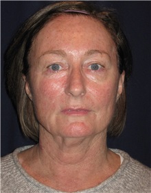 Facelift Before Photo by Gary Culbertson, MD, FACS; Sumter, SC - Case 37761
