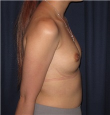 Breast Augmentation Before Photo by Gary Culbertson, MD, FACS; Sumter, SC - Case 37763