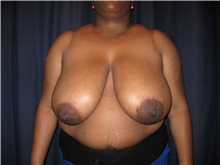 Breast Reduction Before Photo by Gary Culbertson, MD, FACS; Sumter, SC - Case 37764