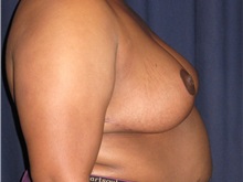 Breast Reduction After Photo by Gary Culbertson, MD, FACS; Sumter, SC - Case 37764