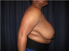 Breast Reduction Before Photo by Gary Culbertson, MD, FACS; Sumter, SC - Case 37764