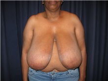 Breast Reduction Before Photo by Gary Culbertson, MD, FACS; Sumter, SC - Case 37765