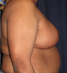 Breast Reduction After Photo by Gary Culbertson, MD, FACS; Sumter, SC - Case 37765