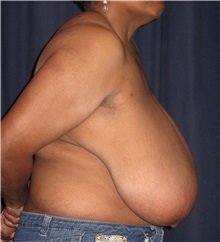 Breast Reduction Before Photo by Gary Culbertson, MD, FACS; Sumter, SC - Case 37765