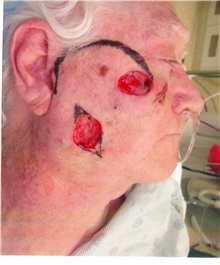 Skin Cancer Removal Before Photo by Gary Culbertson, MD, FACS; Sumter, SC - Case 37769