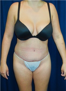 Tummy Tuck After Photo by Gary Culbertson, MD, FACS; Sumter, SC - Case 37772