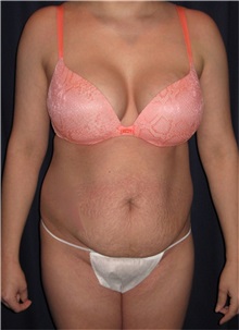 Tummy Tuck Before Photo by Gary Culbertson, MD, FACS; Sumter, SC - Case 37772
