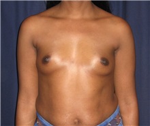 Breast Augmentation Before Photo by Gary Culbertson, MD, FACS; Sumter, SC - Case 37776