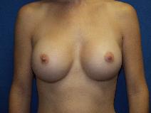 Breast Augmentation After Photo by Paul Ringelman, MD; Towson, MD - Case 7546