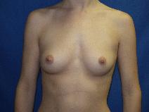 Breast Augmentation Before Photo by Paul Ringelman, MD; Towson, MD - Case 7546