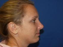 Rhinoplasty After Photo by Paul Ringelman, MD; Towson, MD - Case 7564