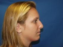 Rhinoplasty Before Photo by Paul Ringelman, MD; Towson, MD - Case 7564