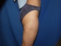 Liposuction After Photo by Paul Ringelman, MD; Towson, MD - Case 7565