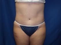 Tummy Tuck After Photo by Paul Ringelman, MD; Towson, MD - Case 7567