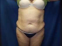 Tummy Tuck Before Photo by Paul Ringelman, MD; Towson, MD - Case 7567