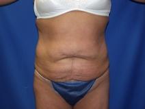 Tummy Tuck Before Photo by Paul Ringelman, MD; Towson, MD - Case 7572